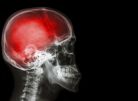 Czy sartany cechują się właściwościami neuroprotekcyjnymi?